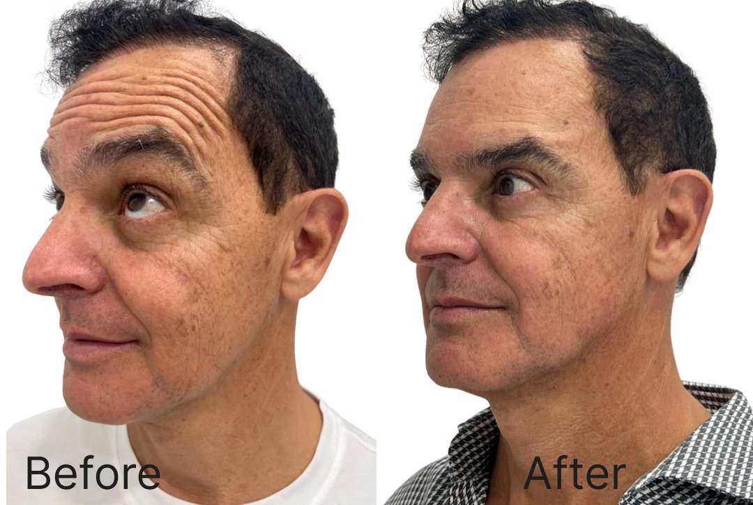 Botox Before & After Image