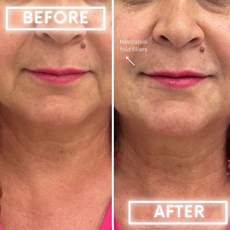 Fillers Before & After Image