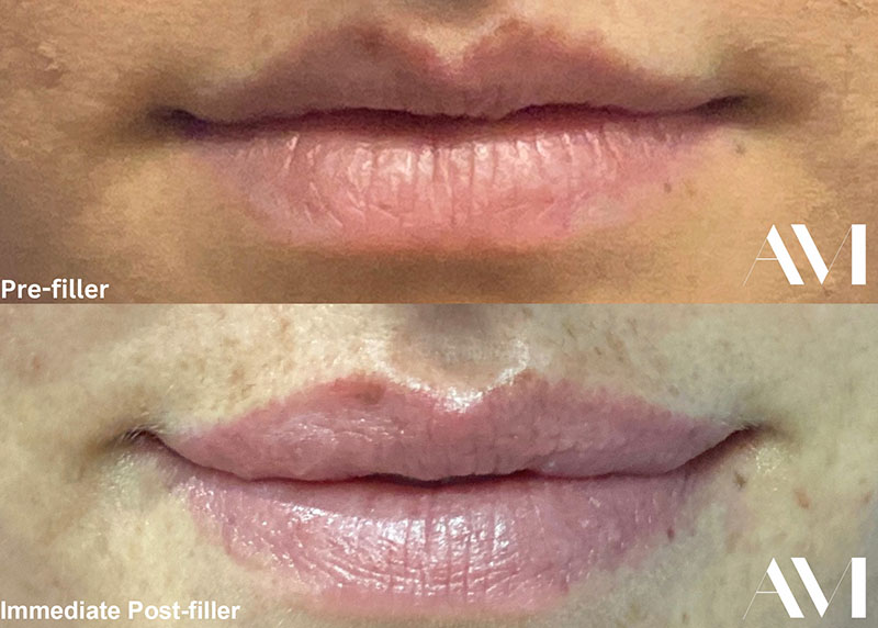 Lip Fillers Before & After Image