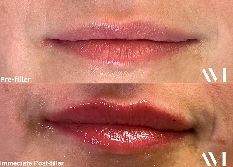 Lip Fillers Before & After Image