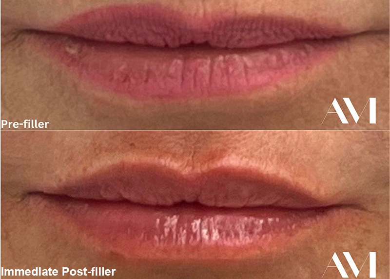 Lip Fillers Before & After Image