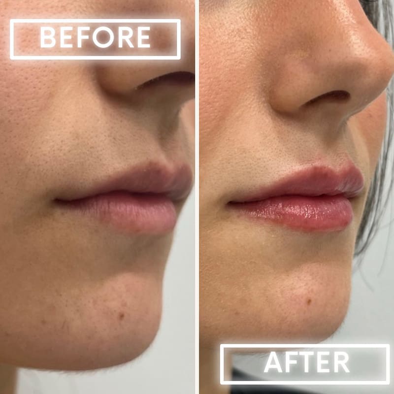 Lip Fillers Before & After Image