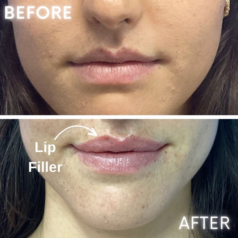 Lip Fillers Before & After Image