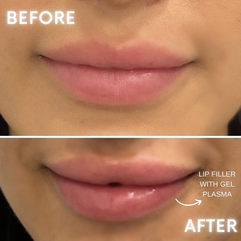 Lip Fillers Before & After Image