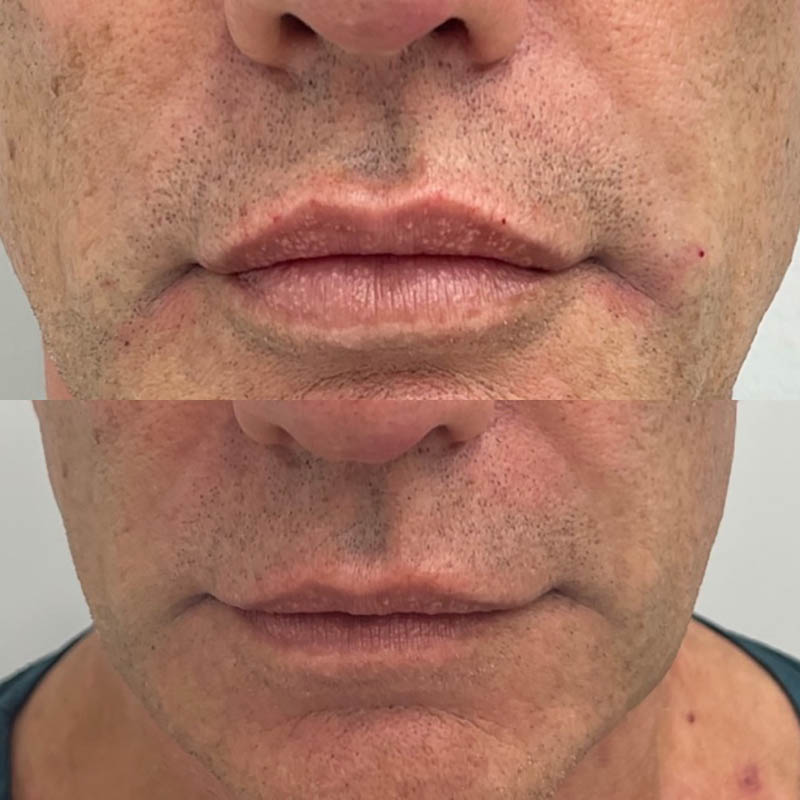 Lip Fillers Before & After Image