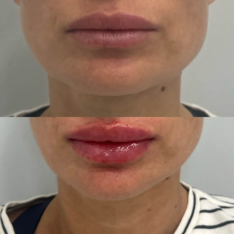 Lip Fillers Before & After Image
