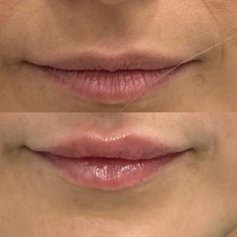 Lip Fillers Before & After Image