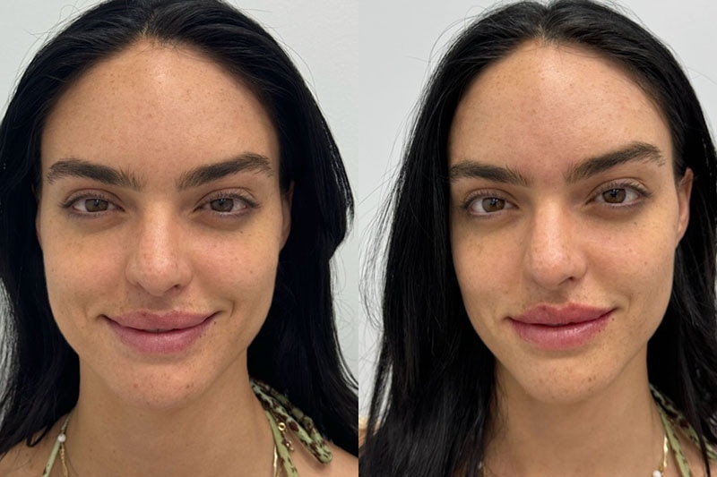 Lip Fillers Before & After Image