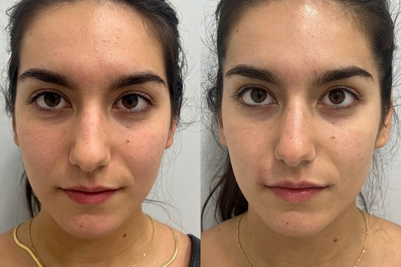 Lip Fillers Before & After Image