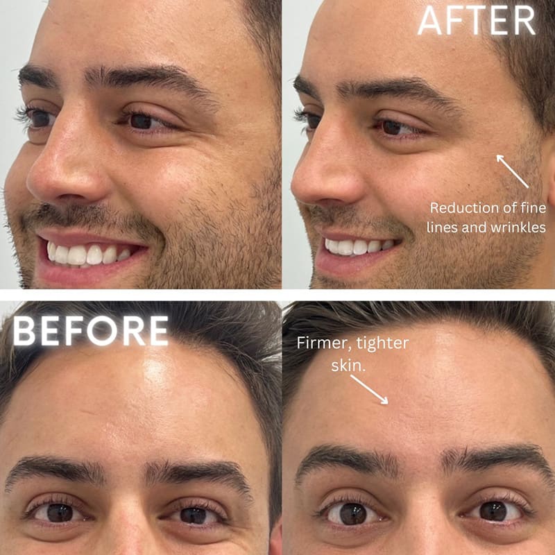 Microneedling Before & After Image