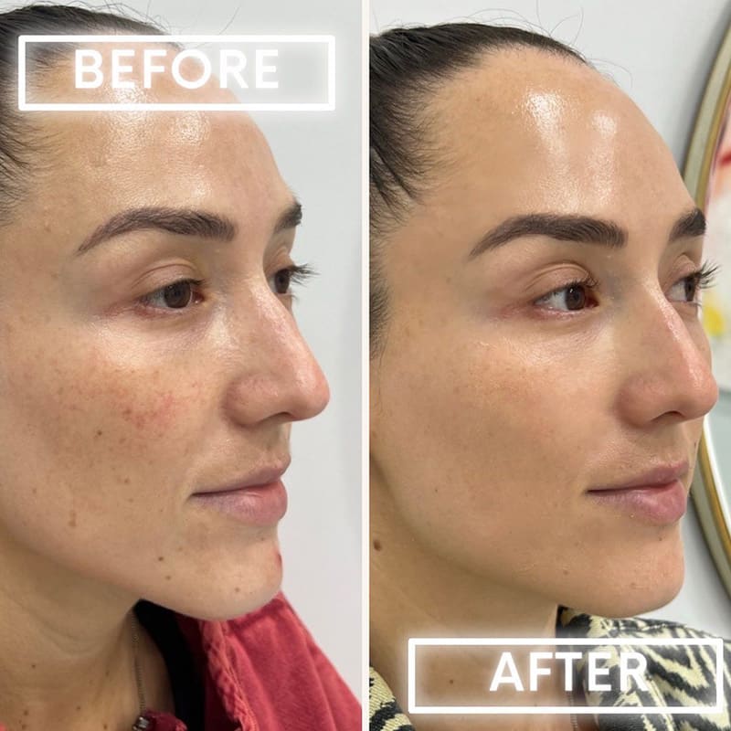 Microneedling Before & After Image